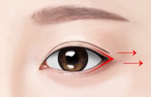 뒤트임 도식 — 눈꼬리 옆 빨간 선과 바깥쪽 화살표